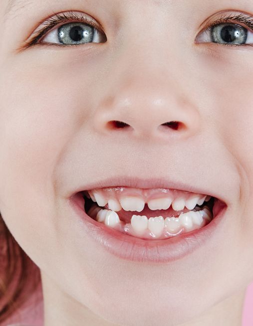 Agenesia dentale nei bambini: cosa fare quando i denti definitivi non si formano