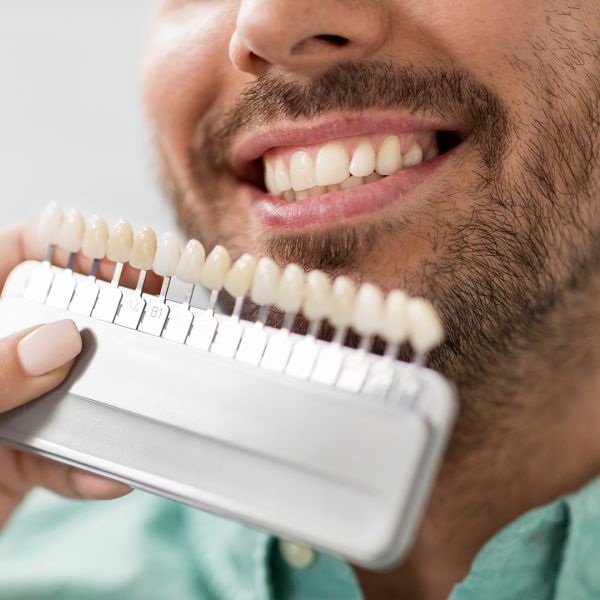 Denti bianchi o denti sani? Cosa sapere sul colore naturale dello smalto