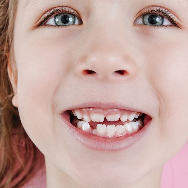Agenesia dentale nei bambini: cosa fare quando i denti definitivi non si formano