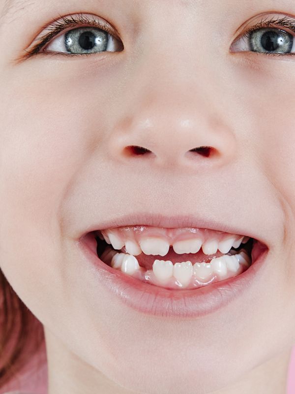 Agenesia dentale nei bambini: cosa fare quando i denti definitivi non si formano