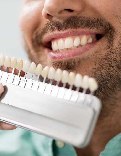 Denti bianchi o denti sani? Cosa sapere sul colore naturale dello smalto