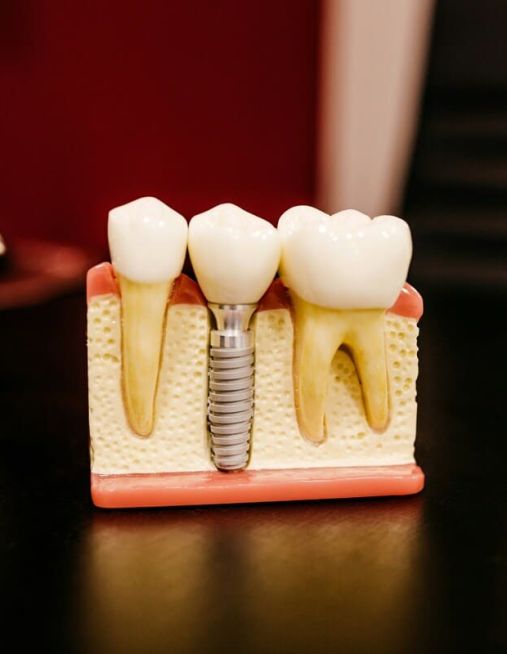 Implantologia dentale: la soluzione per una dentatura fissa e naturale