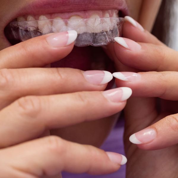 I vantaggi dell’ Ortodonzia invisibile