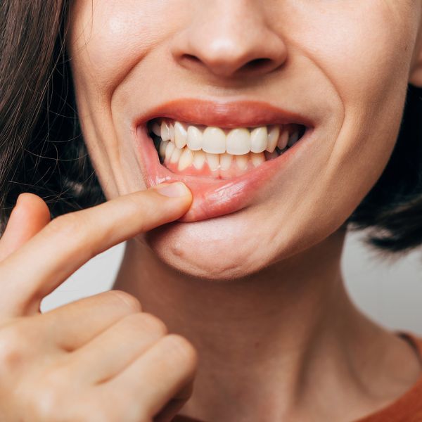 Gengive che sanguinano? Perché non devi ignorare il primo sintomo della Parodontite