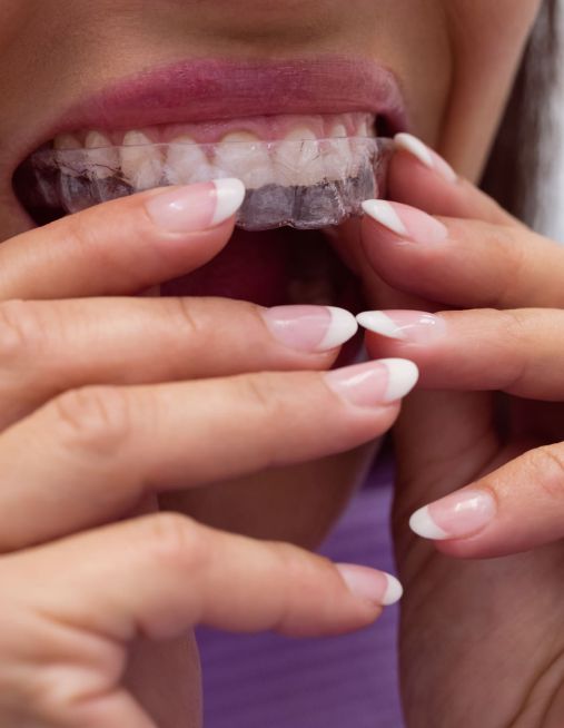 I vantaggi dell’ Ortodonzia invisibile