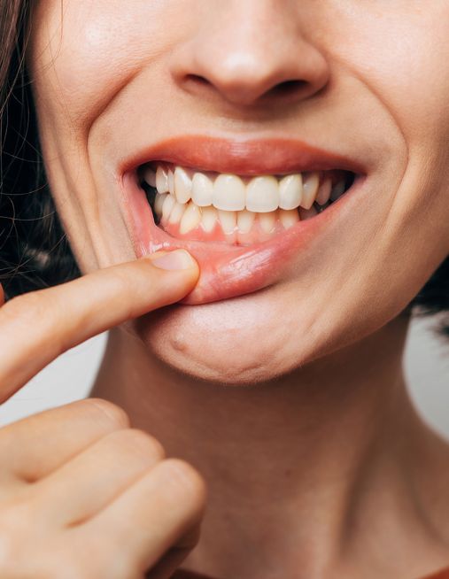 Gengive che sanguinano? Perché non devi ignorare il primo sintomo della Parodontite