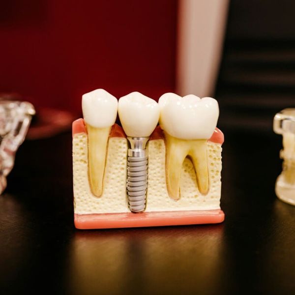 Implantologia dentale: la soluzione per una dentatura fissa e naturale