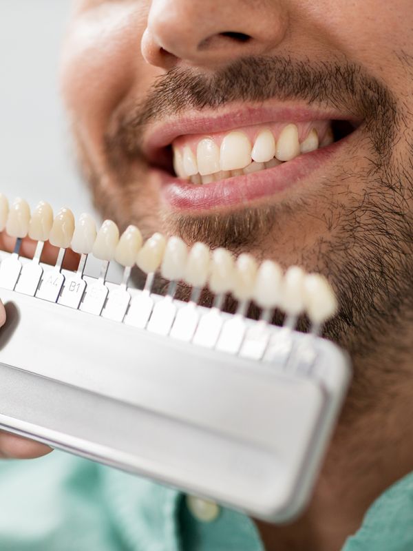 Denti bianchi o denti sani? Cosa sapere sul colore naturale dello smalto